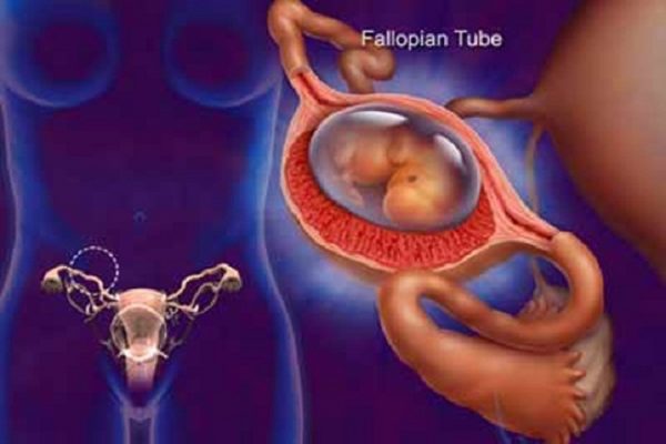 Mang thai ngoài tử cung là gì