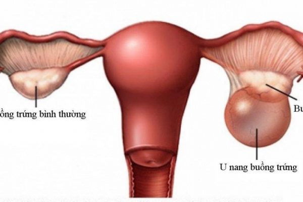 5 dấu hiệu nhận biết u nang buồng trứng